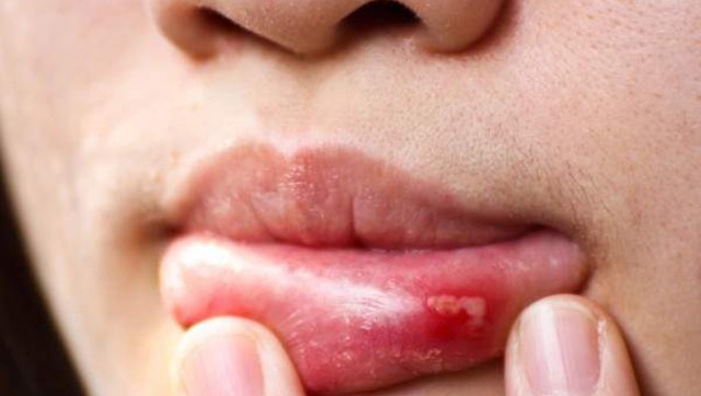 Top 20 why do i keep biting my cheeks 3 What are the harmful consequences of inner cheek biting?