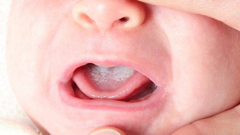 White layer on a tongue | White colored tongue
