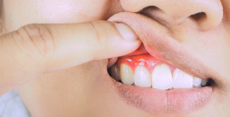 home remedies for gum swelling