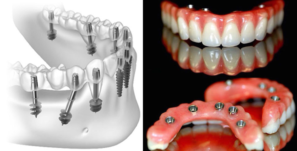 Basal Dental Implants BiCortical Dental Implants