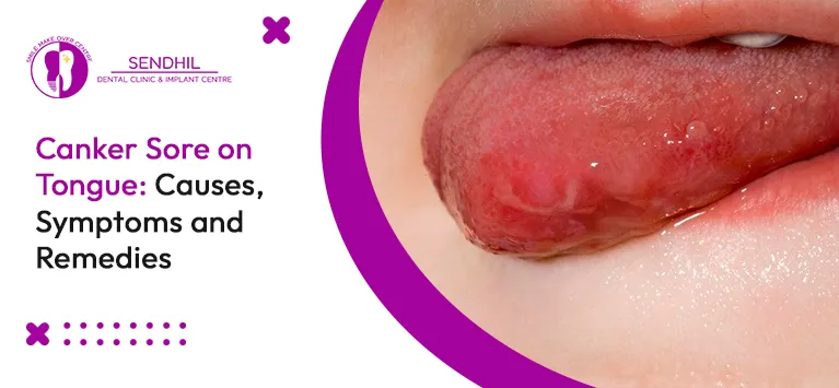 Blisters on tongue sales